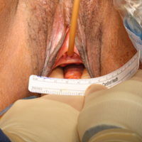 Vaginoplasty: Patient 1