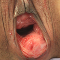Vaginoplasty: Patient 3