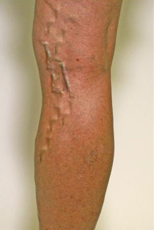 Spider Vein Treatment