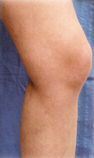 Varicose Vein Treatment