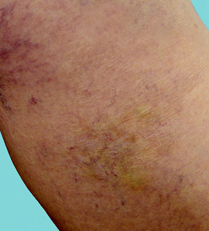 Sclerotherapy