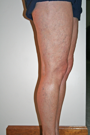 Sclerotherapy