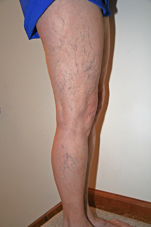 Sclerotherapy