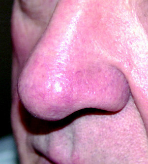 Facial Telangiectasia