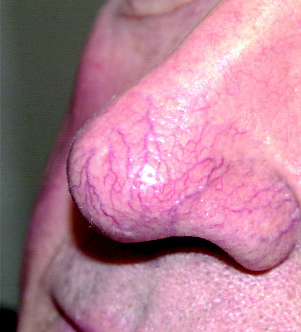 Facial Telangiectasia