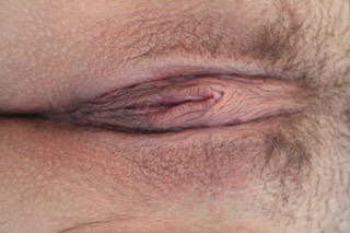 Labiaplasty