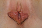Labiaplasty: Patient 2