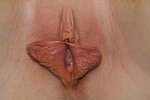 Labiaplasty: Patient 2