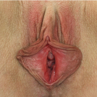 Labiaplasty: Patient 25